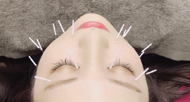 美顔鍼(美容鍼)